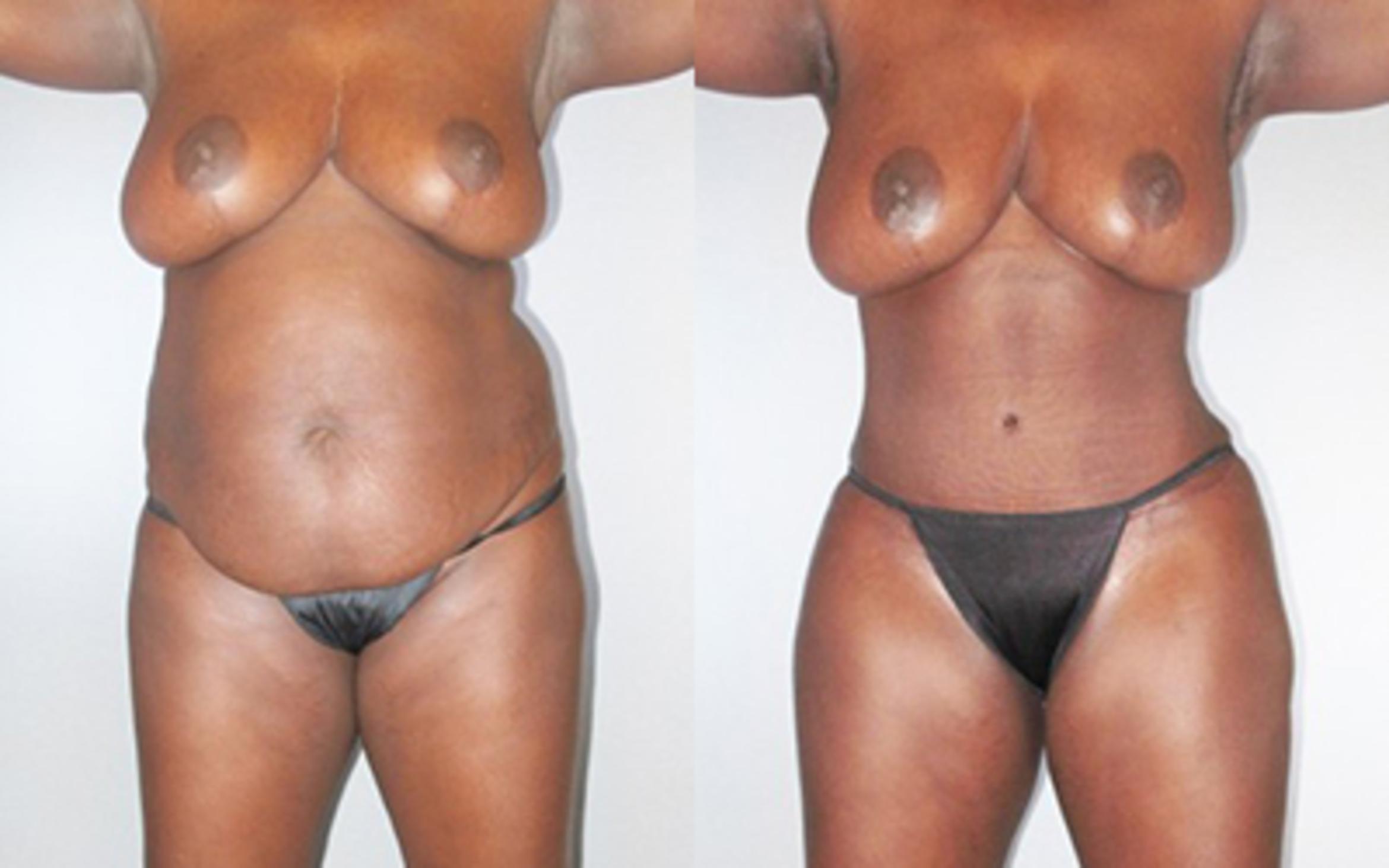 Before & After Tummy Tuck Case 9280 View 1 View in Houston, TX