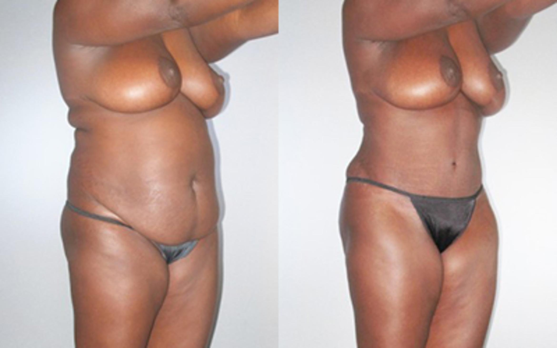 Before & After Tummy Tuck Case 9280 View 2 View in Houston, TX