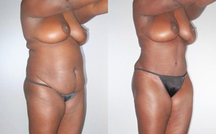Before & After Tummy Tuck Case 9280 View 2 View in Houston, TX