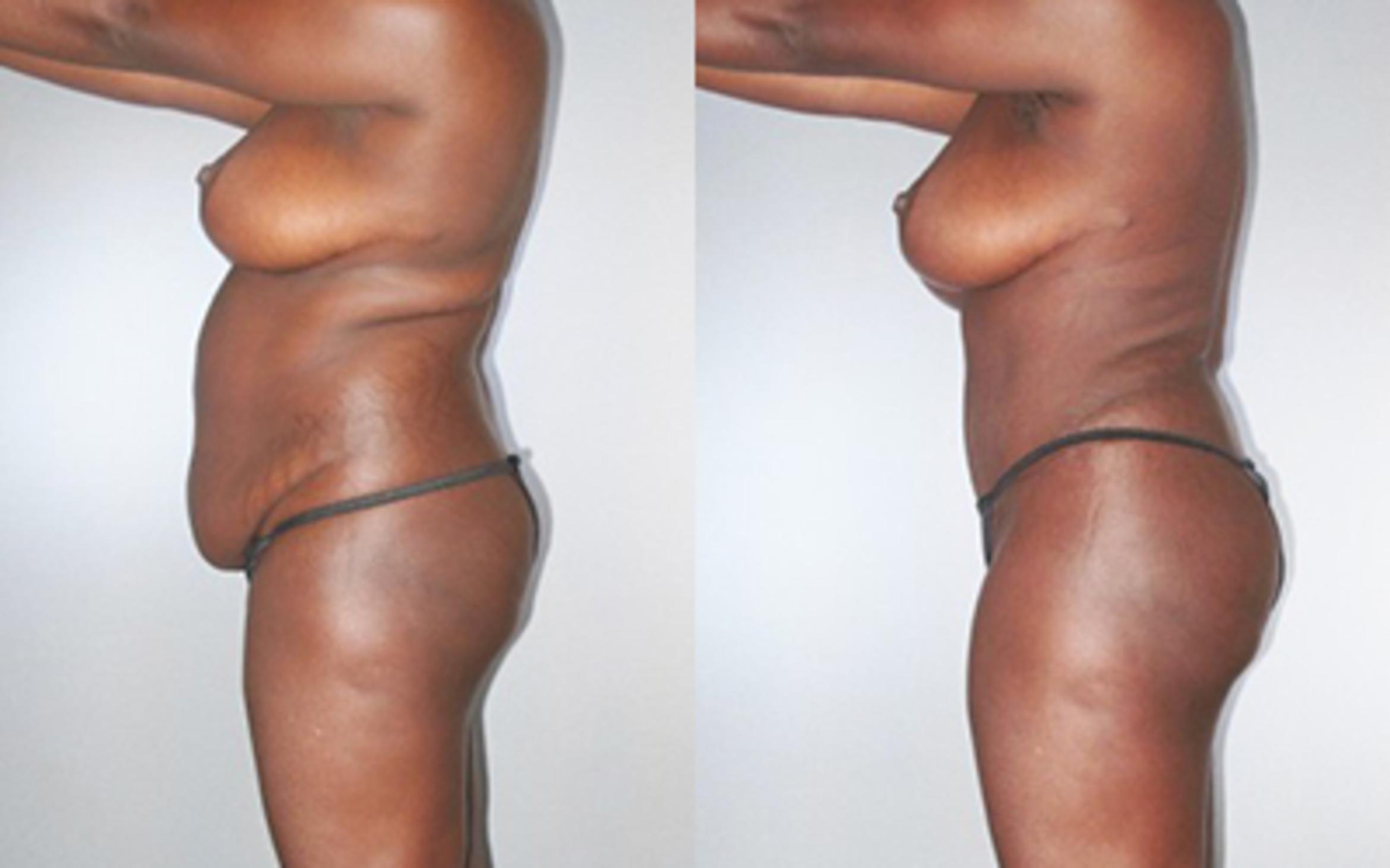 Before & After Tummy Tuck Case 9280 View 3 View in Houston, TX