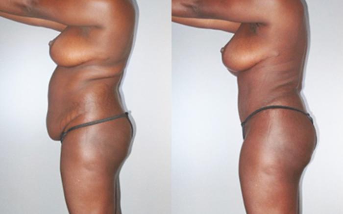 Before & After Tummy Tuck Case 9280 View 3 View in Houston, TX