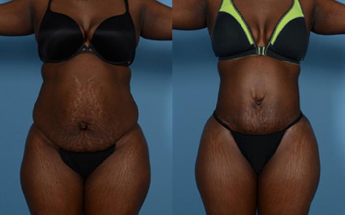 Before & After Tummy Tuck Case 9568 View 1 View in Houston, TX