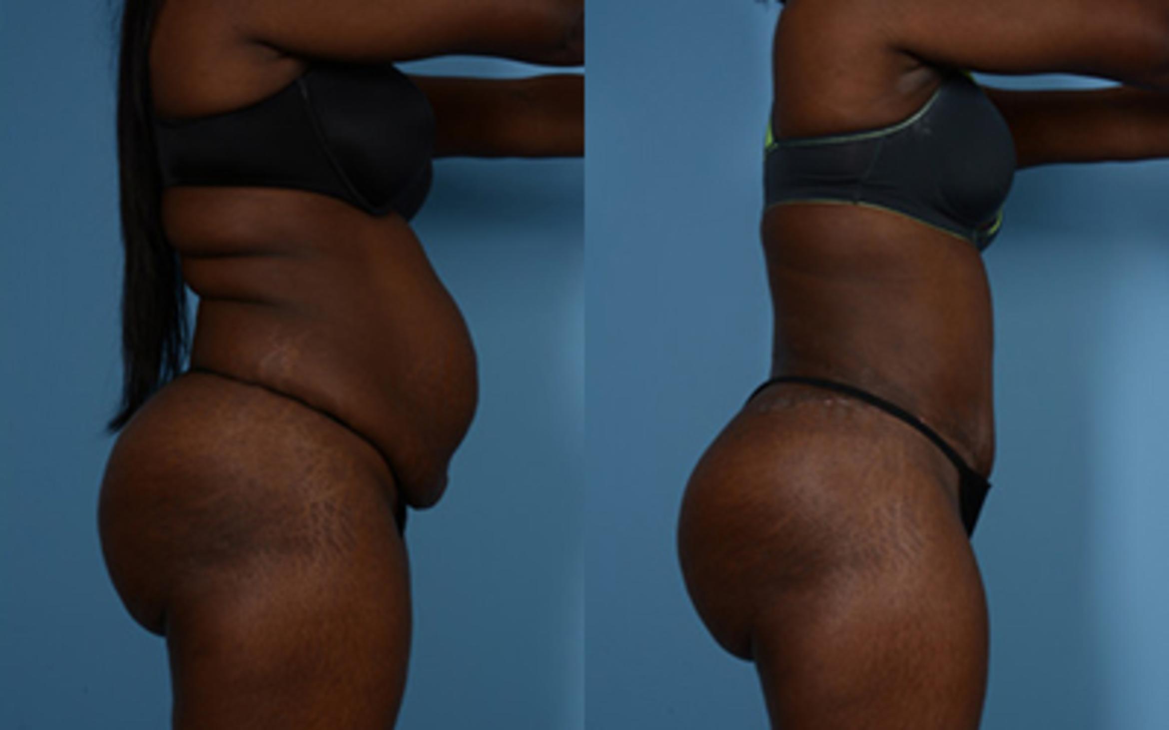 Before & After Tummy Tuck Case 9568 View 2 View in Houston, TX
