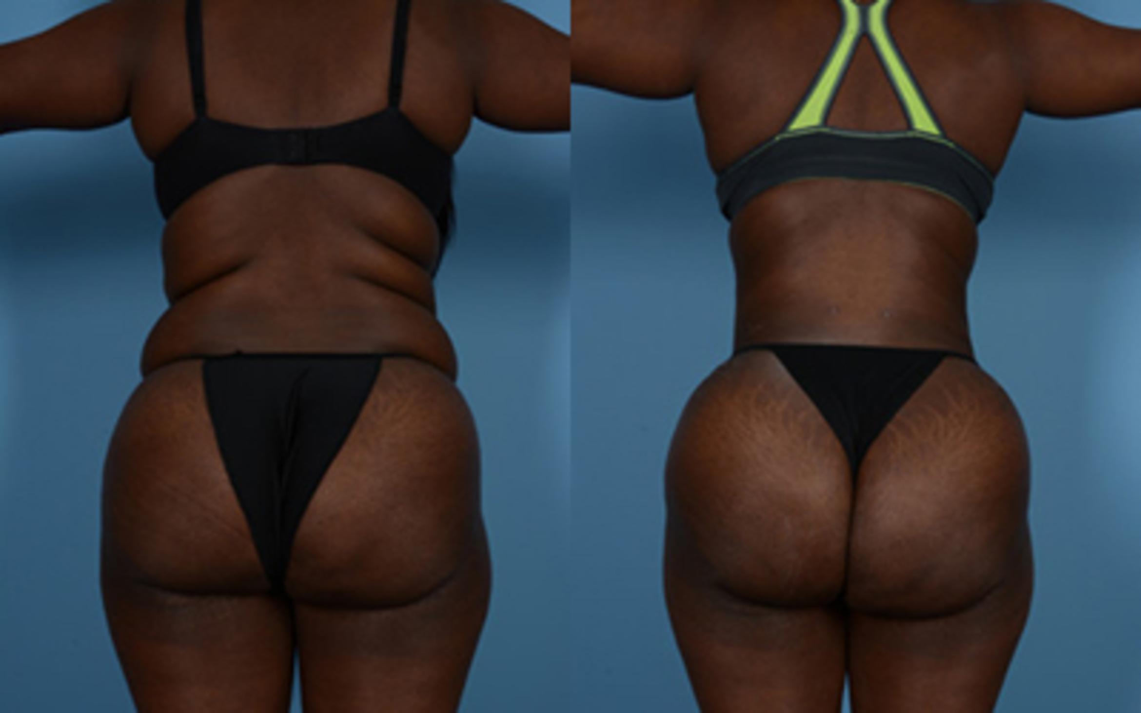 Before & After Tummy Tuck Case 9568 View 3 View in Houston, TX