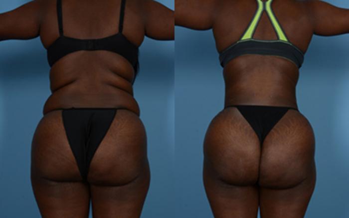 Before & After Tummy Tuck Case 9568 View 3 View in Houston, TX