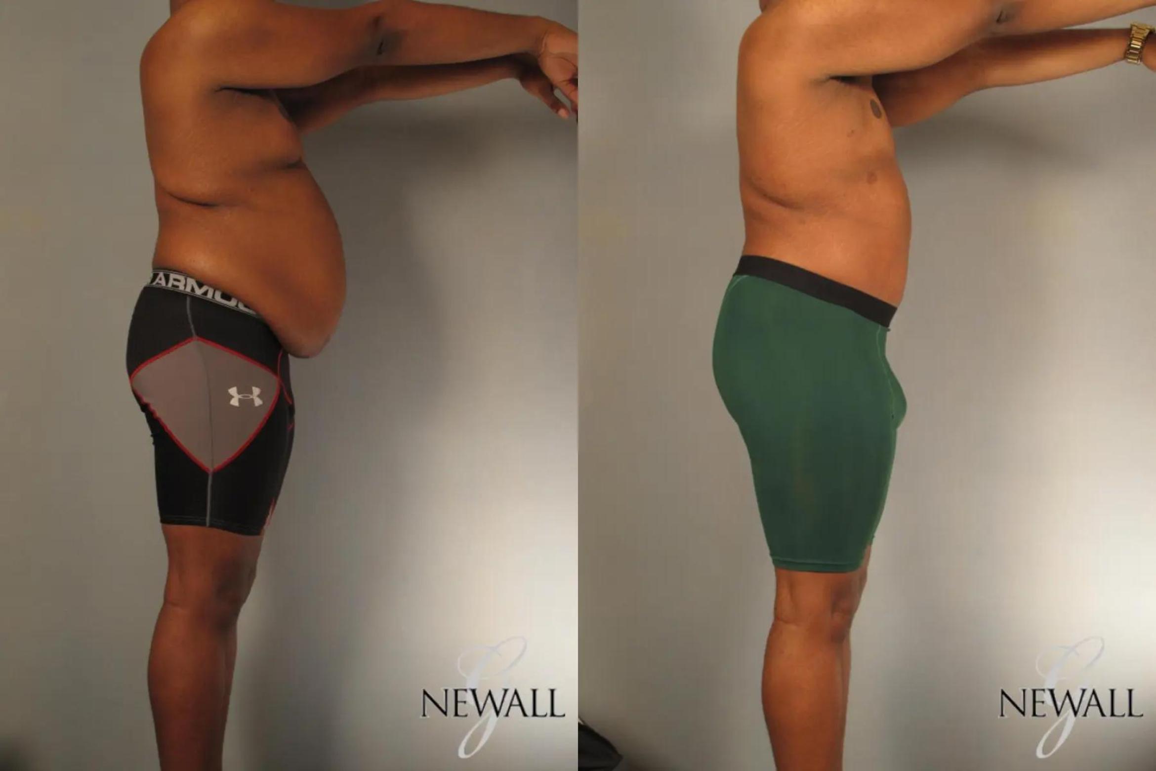 Before & After Tummy Tuck For Men Case 17812 View 3 View in Houston, TX