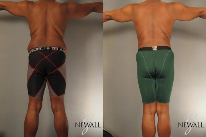 Before & After Tummy Tuck For Men Case 17812 View 5 View in Houston, TX